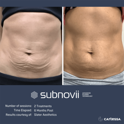 Subnovii Plasma Pen Before and After By Enchanted Medical Aesthetics