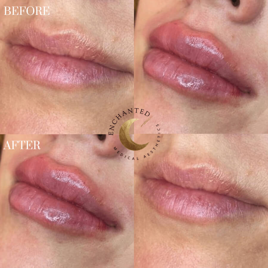 Lip Filler Before and After Photos By Enchanted Medical Aesthetics