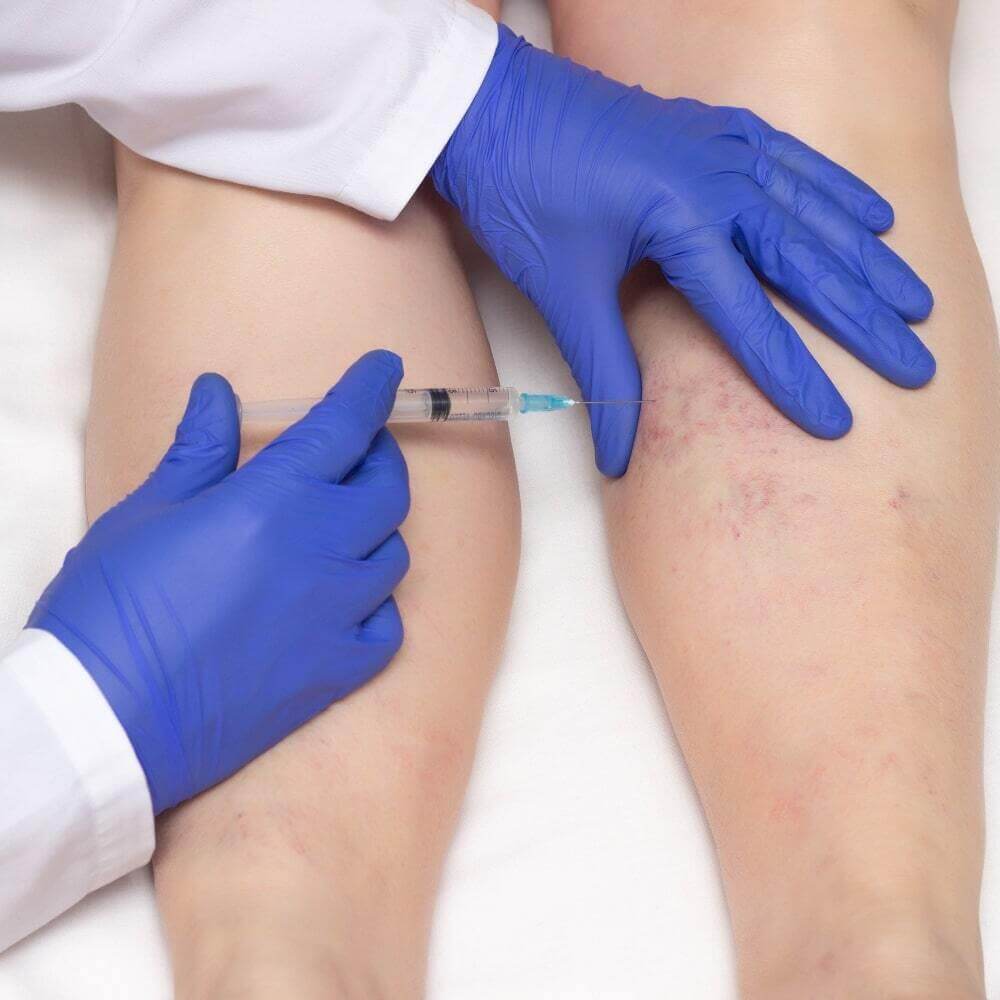 Sclerotherapy in Ormond Beach,FL