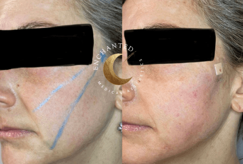 Thread Lift Before and After By Enchanted Medical Aesthetics