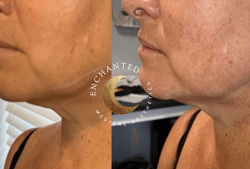 Thread Lift Before and After By Enchanted Medical Aesthetics