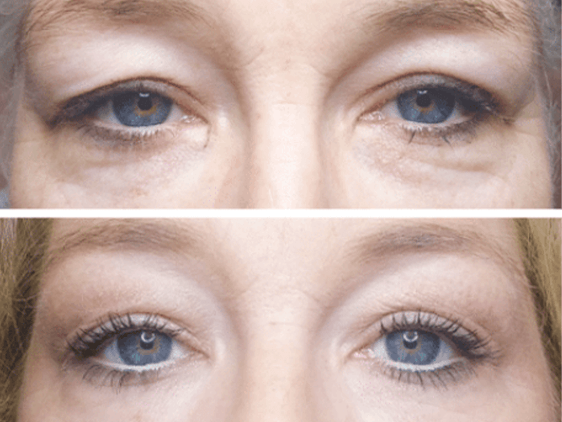 Subnovii Plasma Pen Treatment Before and After By Enchanted Medical Aesthetics