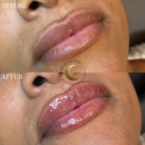 Lip Filler Before and After By Enchanted Medical Aesthetics