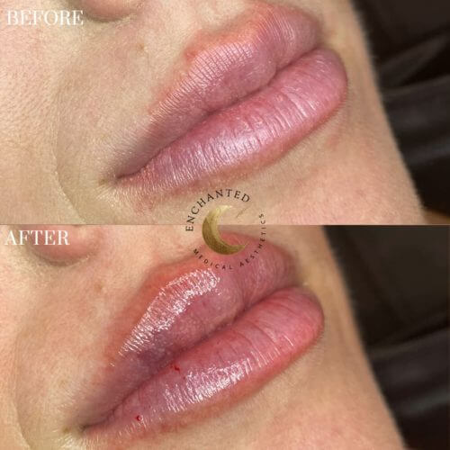 Lip Filler Before and After By Enchanted Medical Aesthetics