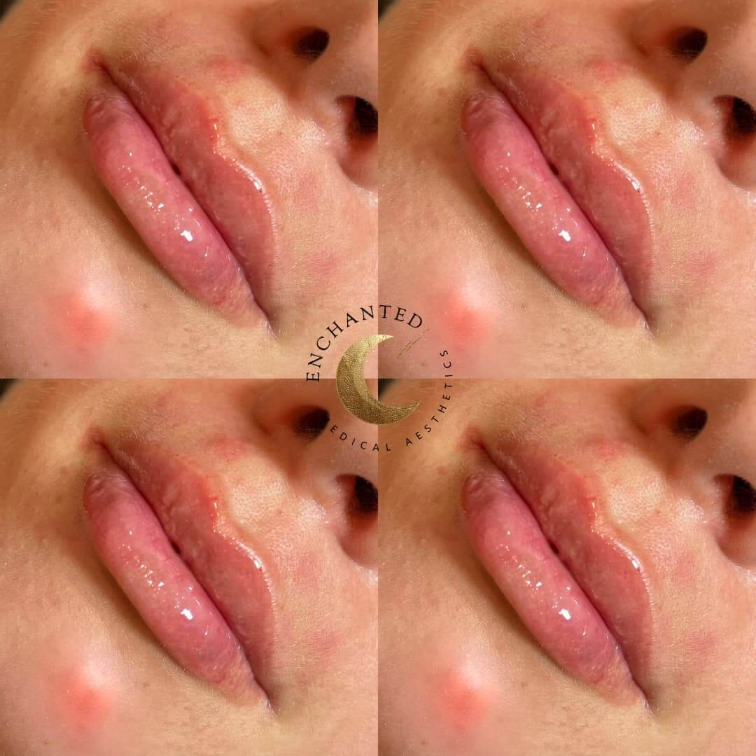 Lip Filler Before and After By Enchanted Medical Aesthetics