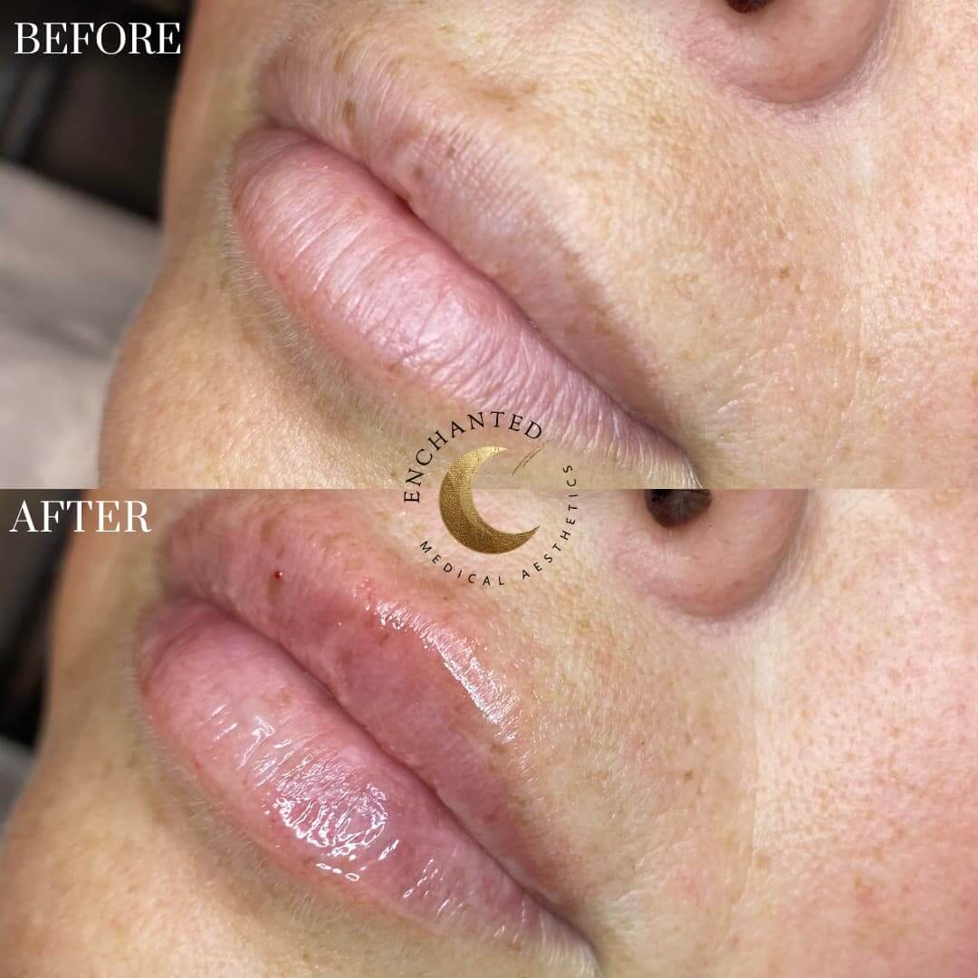 Lip Filler Injection Before and After By Enchanted Medical Aesthetics