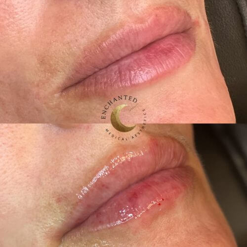 Lip Filler Service Before and After By Enchanted Medical Aesthetics