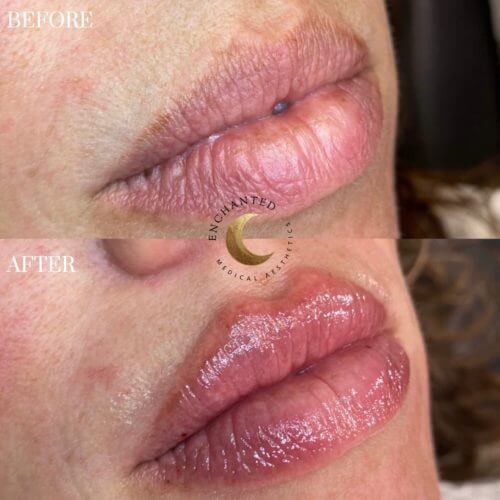 Lip Filler Before and After By Enchanted Medical Aesthetics