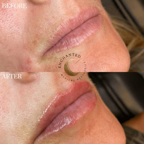 Lip Filler Before and After By Enchanted Medical Aesthetics
