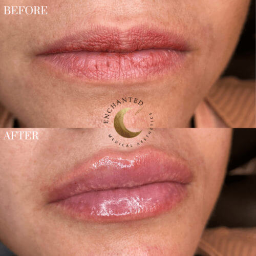 Lip Filler Before and After By Enchanted Medical Aesthetics