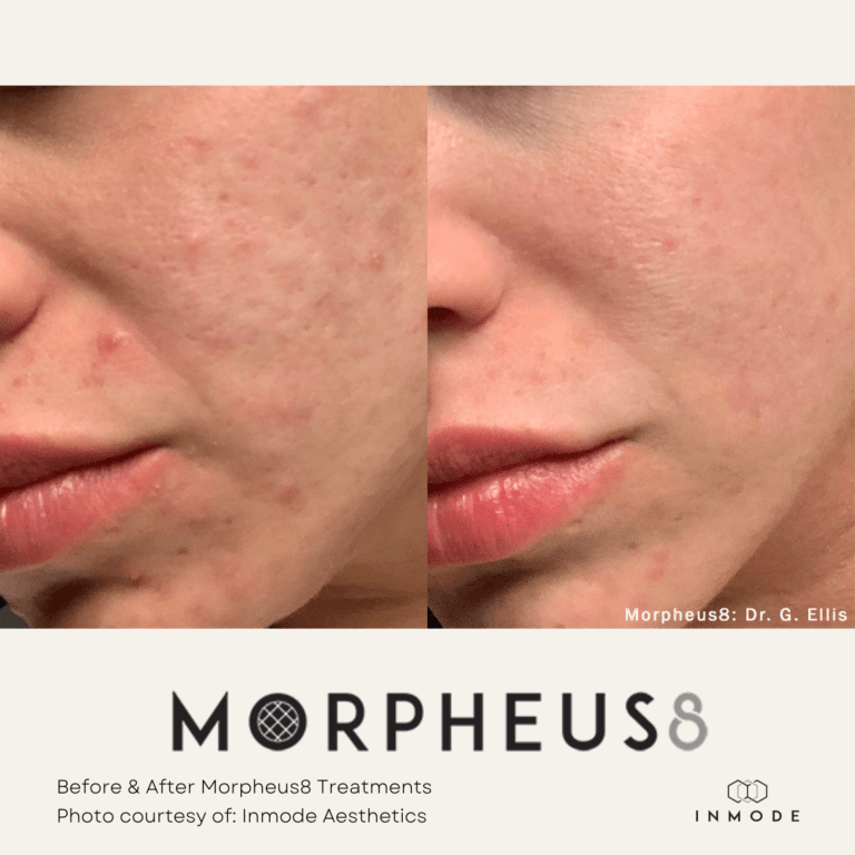 Morpheus8 Treatment Before and After By Enchanted Medical Aesthetics