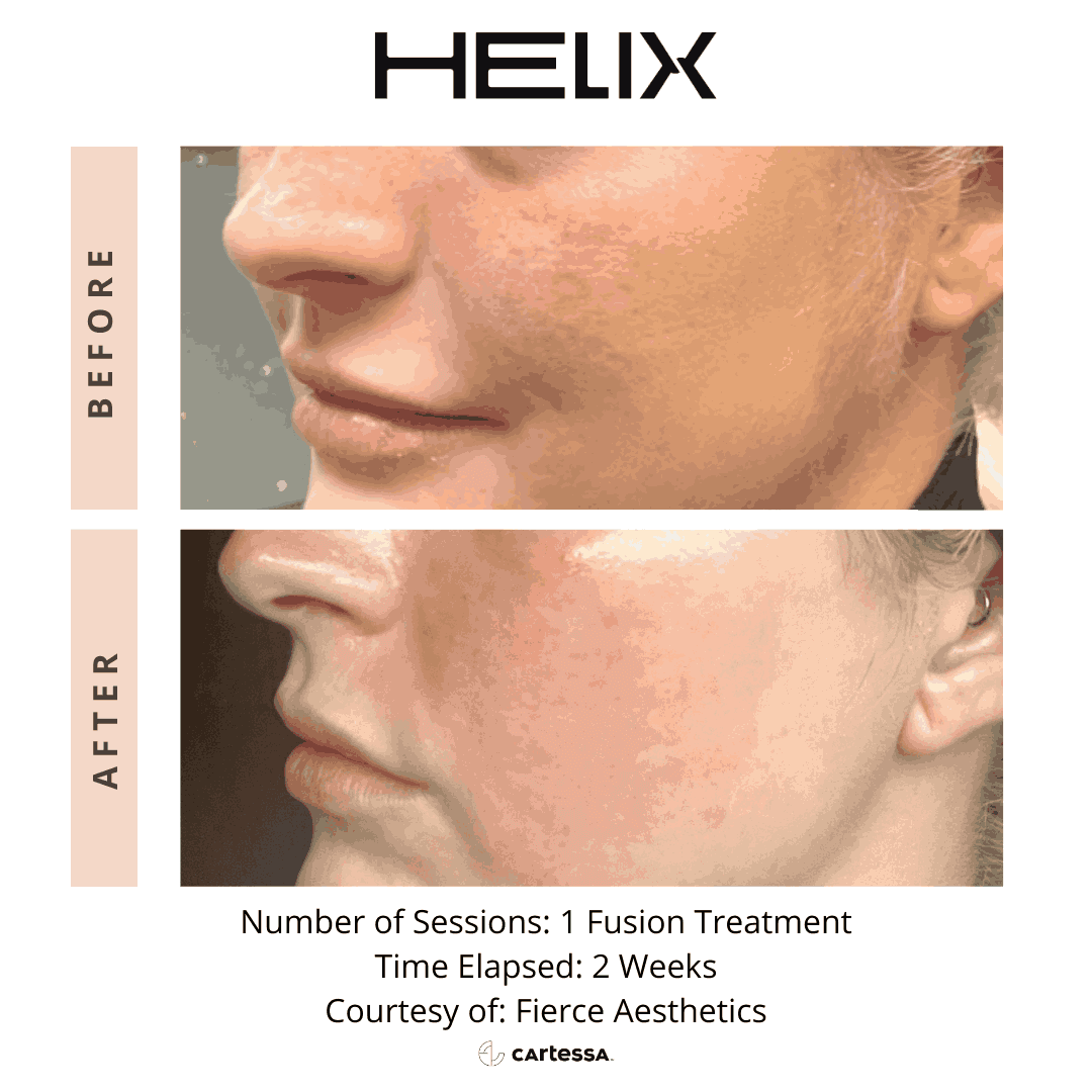 Helix Before and After By Enchanted Medical Aesthetics