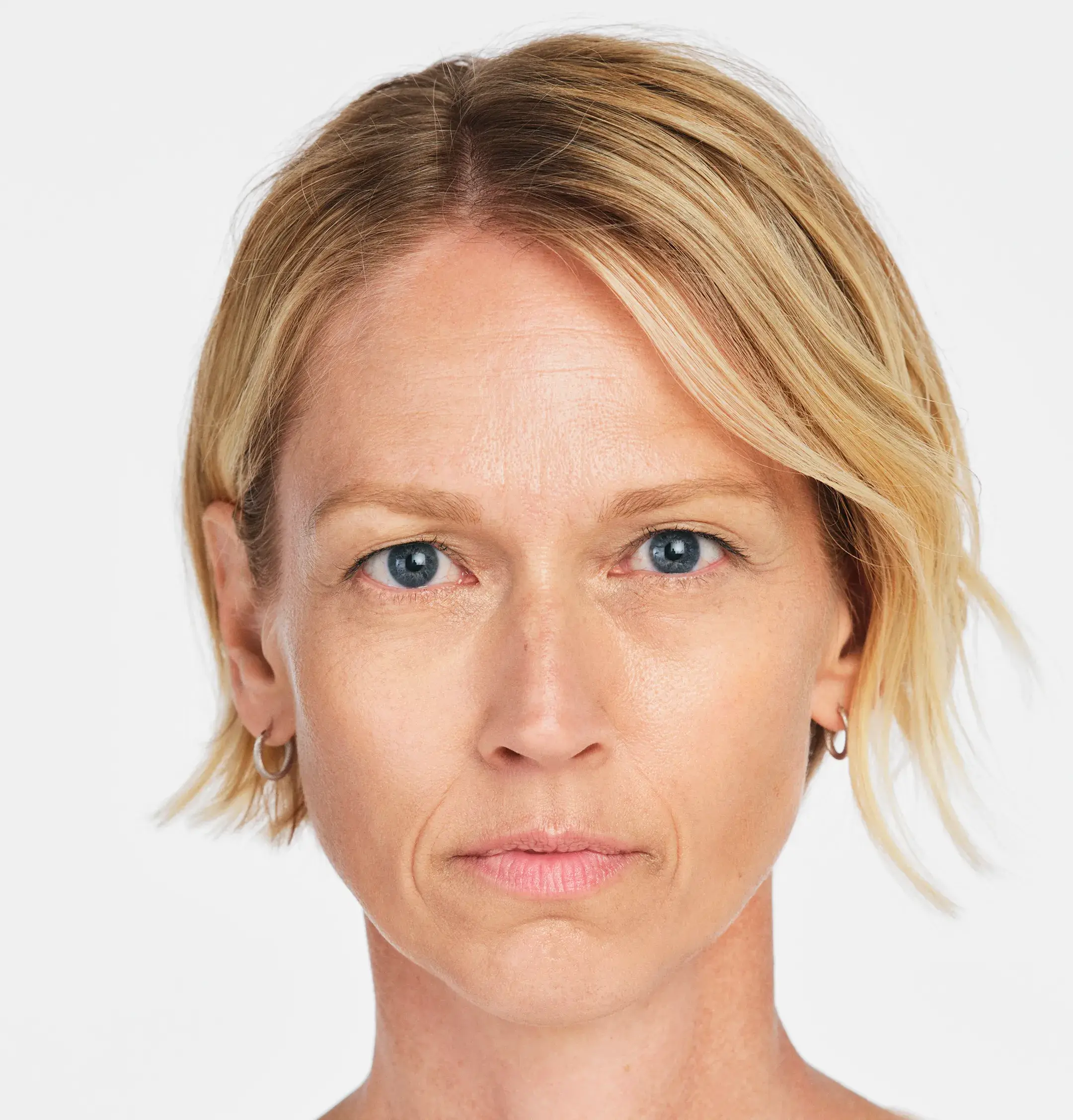 Radiesse Treatment Before Photo By Enchanted Medical Aesthetics