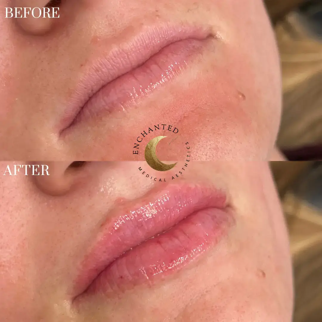 Filler one Before and after