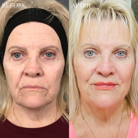Liquid Facelift