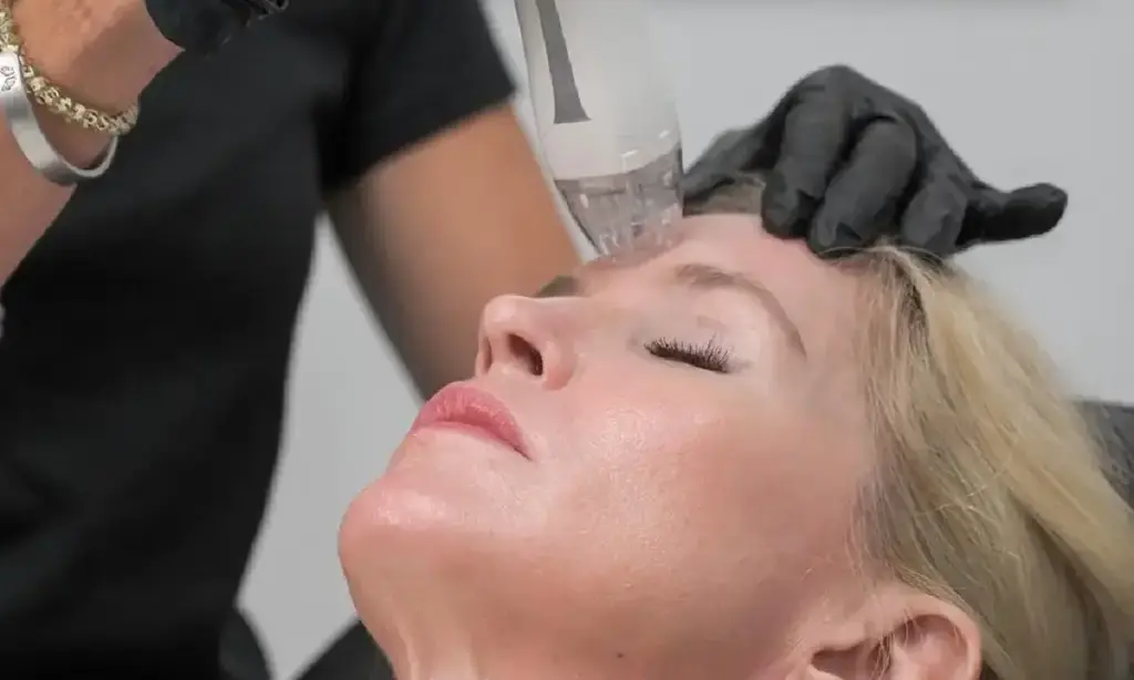 RF Microneedling Improves Sagging Skin in Ormond Beach